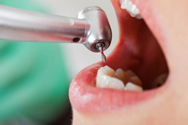 Best Emergency Dental Care for Sports Injuries in Chico, WA